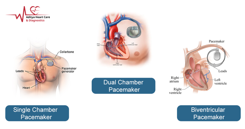 Types of Pacemaker - Heart specialist Indore