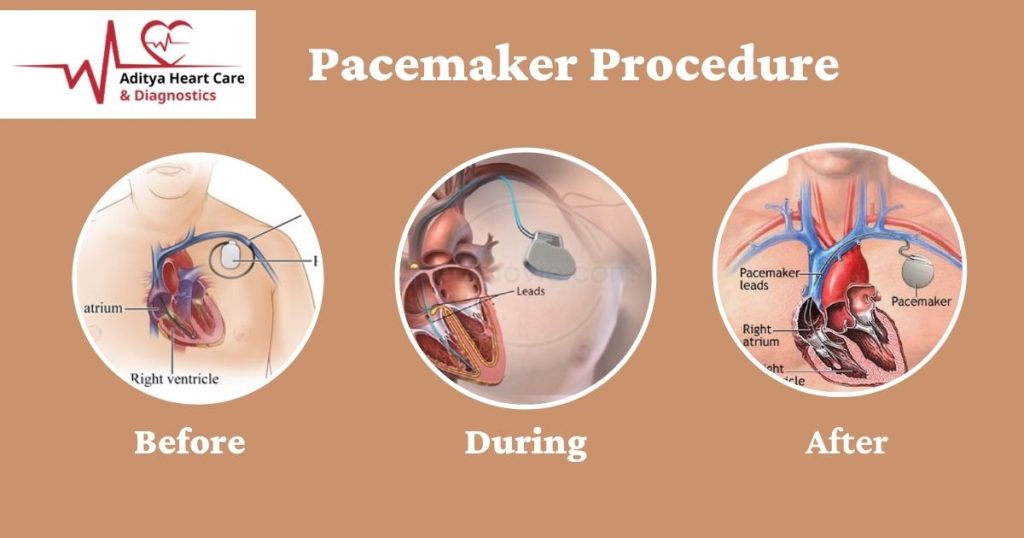 Pacemaker Procedure - Heart specialist Indore