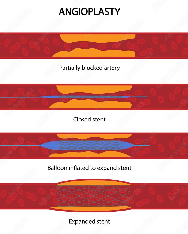 Step-by-step illustration of the angioplasty procedure showing stent placement to treat blocked arteries, representing Angioplasty Treatment in Indore by Dr. Akhilesh Jain.