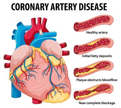 Diagram showing progression of coronary artery disease in heart arteries, from healthy artery to near complete blockage due to fatty plaque deposits.