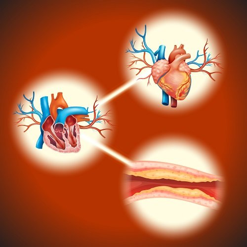 Medical graphic showing heart, arteries, and detailed cross-section of artery blockage, representing Angioplasty Treatment in Indore by Dr. Akhilesh Jain.