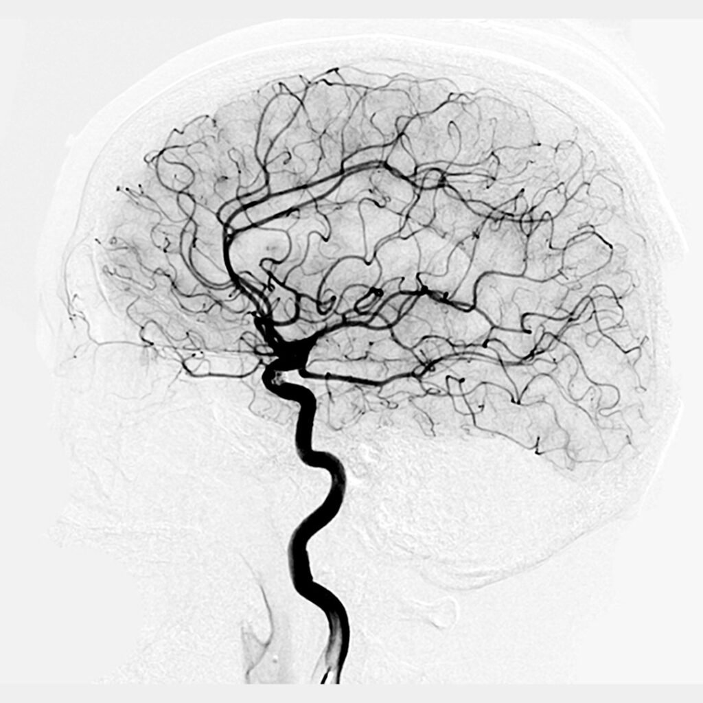 Medical angiography scan showing intricate blood vessels in the human brain, representing expert Angiography in Indore by Dr. Akhilesh Jain.