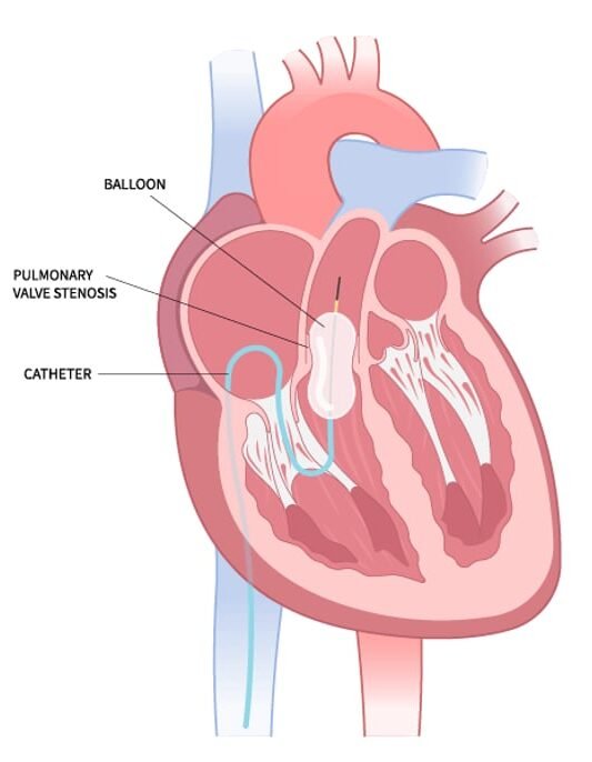 Labeled medical illustration of a heart showing balloon valvuloplasty procedure for pulmonary valve stenosis, representing Balloon Valvuloplasty Treatment in Indore by Dr. Akhilesh Jain.
