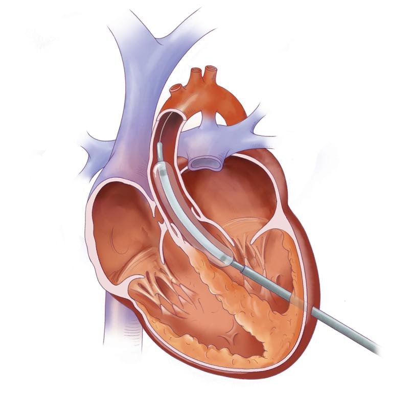 Medical illustration showing balloon valvuloplasty procedure inside the heart, representing Balloon Valvuloplasty Treatment in Indore by Dr. Akhilesh Jain.
