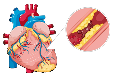 Diagram of a human heart with a zoomed-in view showing plaque buildup causing coronary artery blockage, used to explain coronary artery disease.