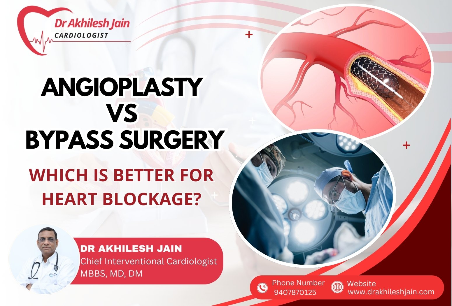 Angioplasty vs bypass surgery for heart blockage explained by Dr. Akhilesh Jain, interventional cardiologist.